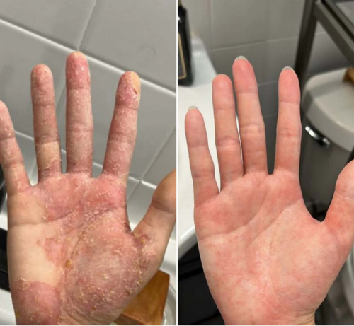 Kräm mot Hudinflammation & Hälsosam Hud – Lindrar klåda, rodnad och fjällning 50ml photo review